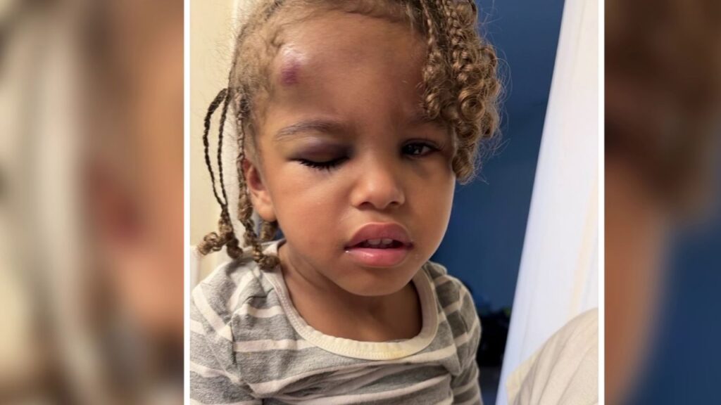 3-Year-Old Returns From North Carolina Daycare With Swollen Eyes, Mother Demands Answers