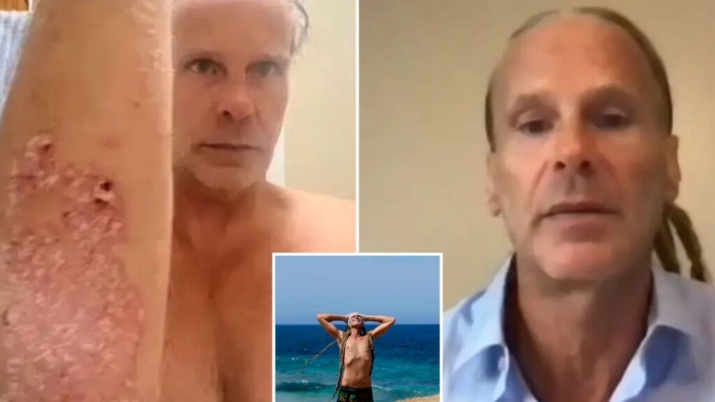 Florida Man Says Decades of Psoriasis, Pain and Depression Disappeared After He Switched to a Meat-Only “Lion Diet”